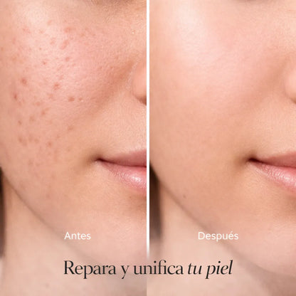 El Glow Natural que necesitas | ¿Te quedaron marcas de acné que no se van?